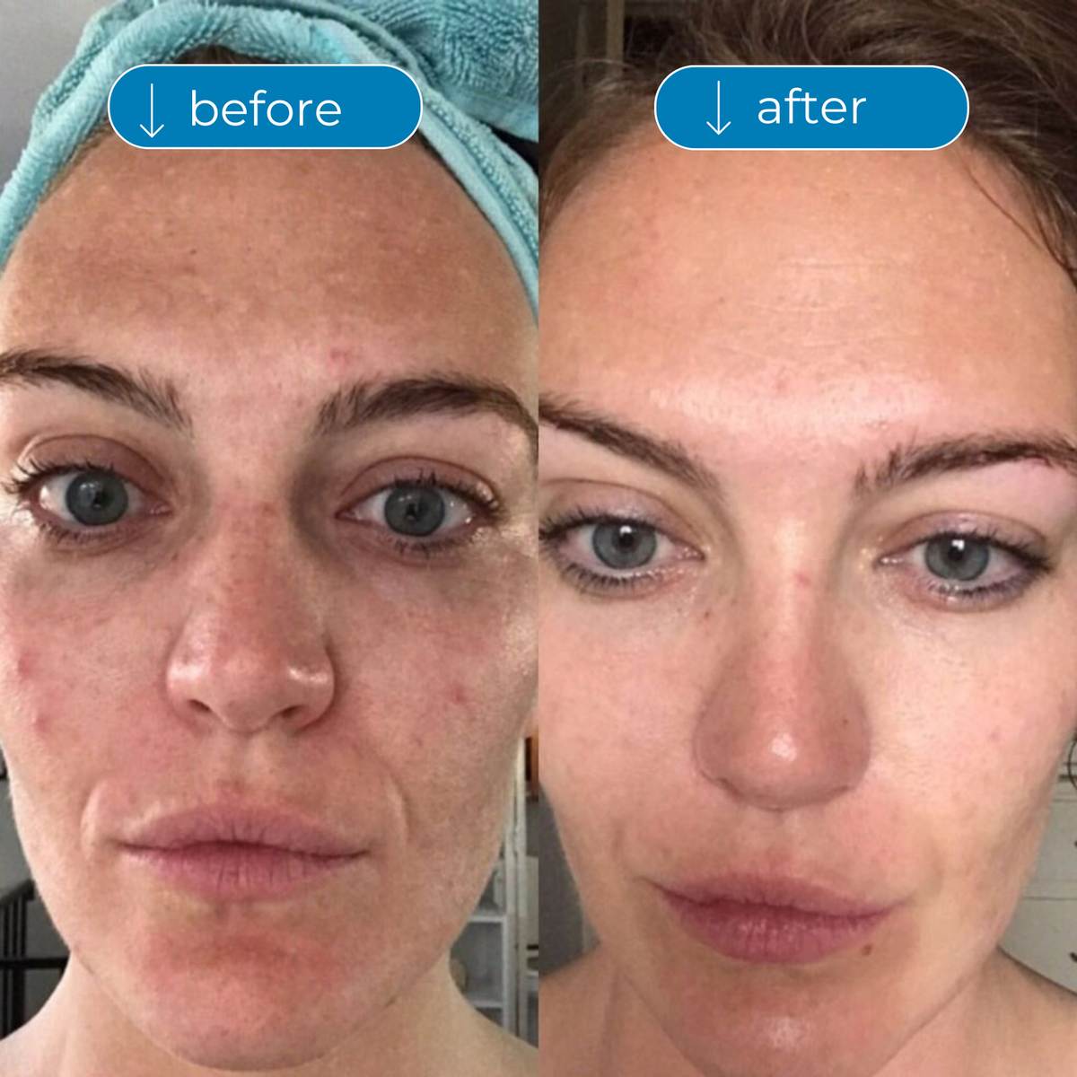 Collagen Peptides