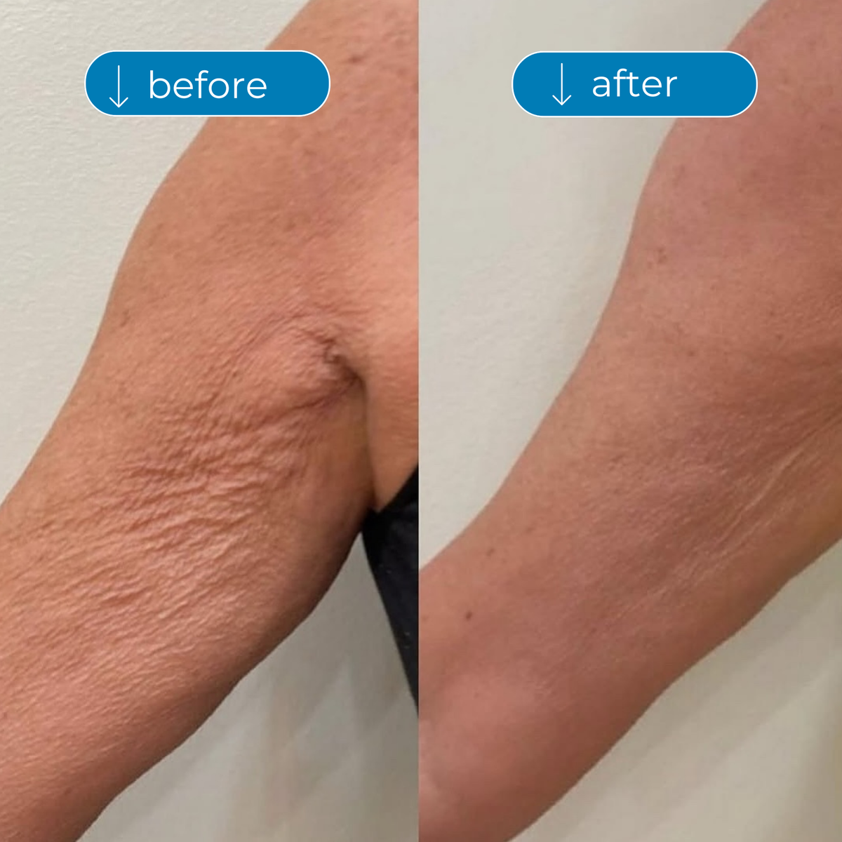 Collagen Peptides